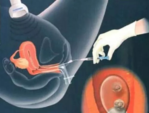 卵巢早衰跟马来西亚试管婴儿促排卵有关？