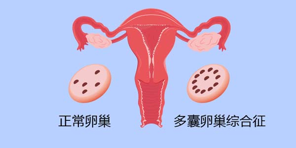多囊女性想做试管婴儿，这5个问题你得知道!