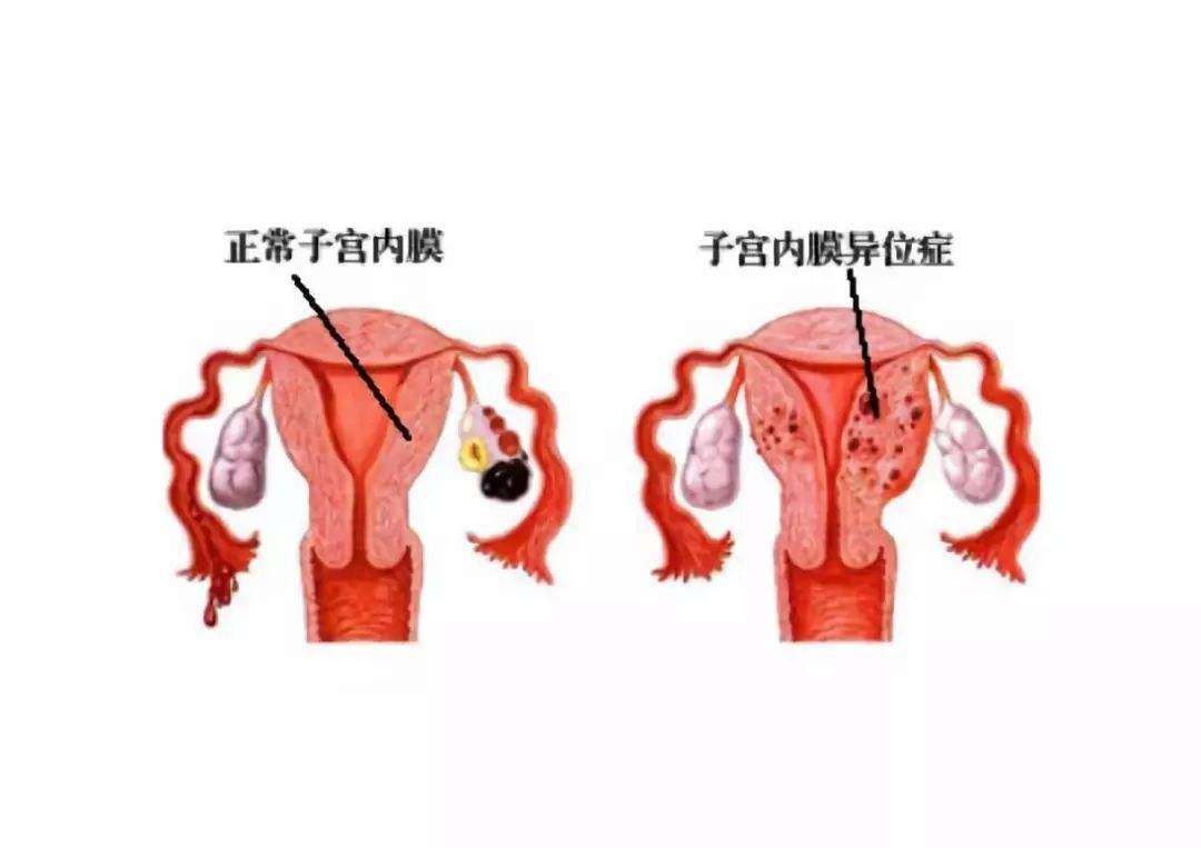子宫内膜异位症必须要选择试管婴儿吗？