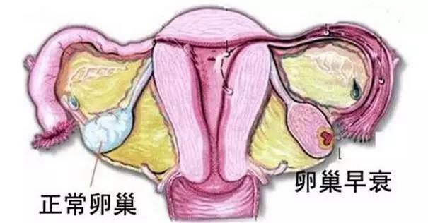 马来西亚试管婴儿卵巢早衰的女性有哪些表现?