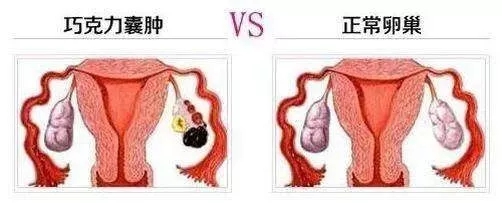 患有巧囊就真的不孕，试管婴儿一次成功！
